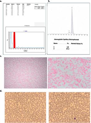 Homozygous Delta-Beta Thalassaemia With Alpha Thalassaemia and Erythrocytosis- a Rare Case Report